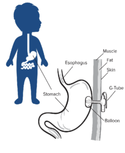 How a Gastrostomy
Tube works